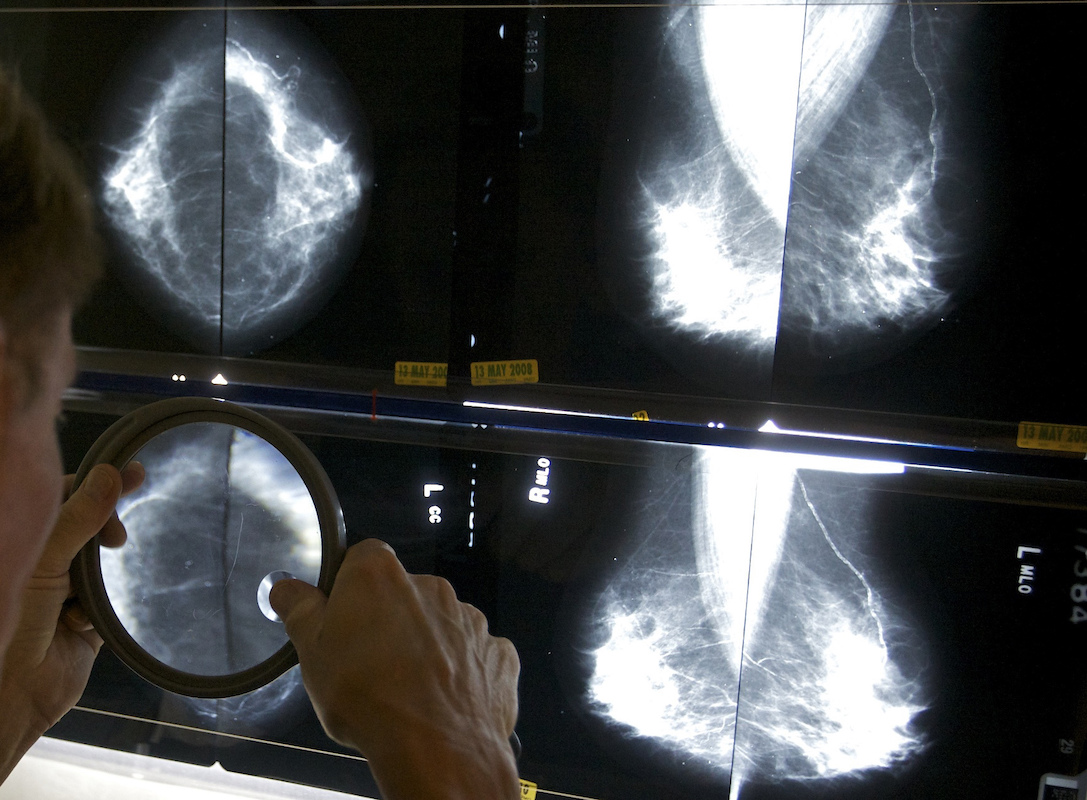 Radiologist inspects mammogram in Los Angeles, 5-6-2010