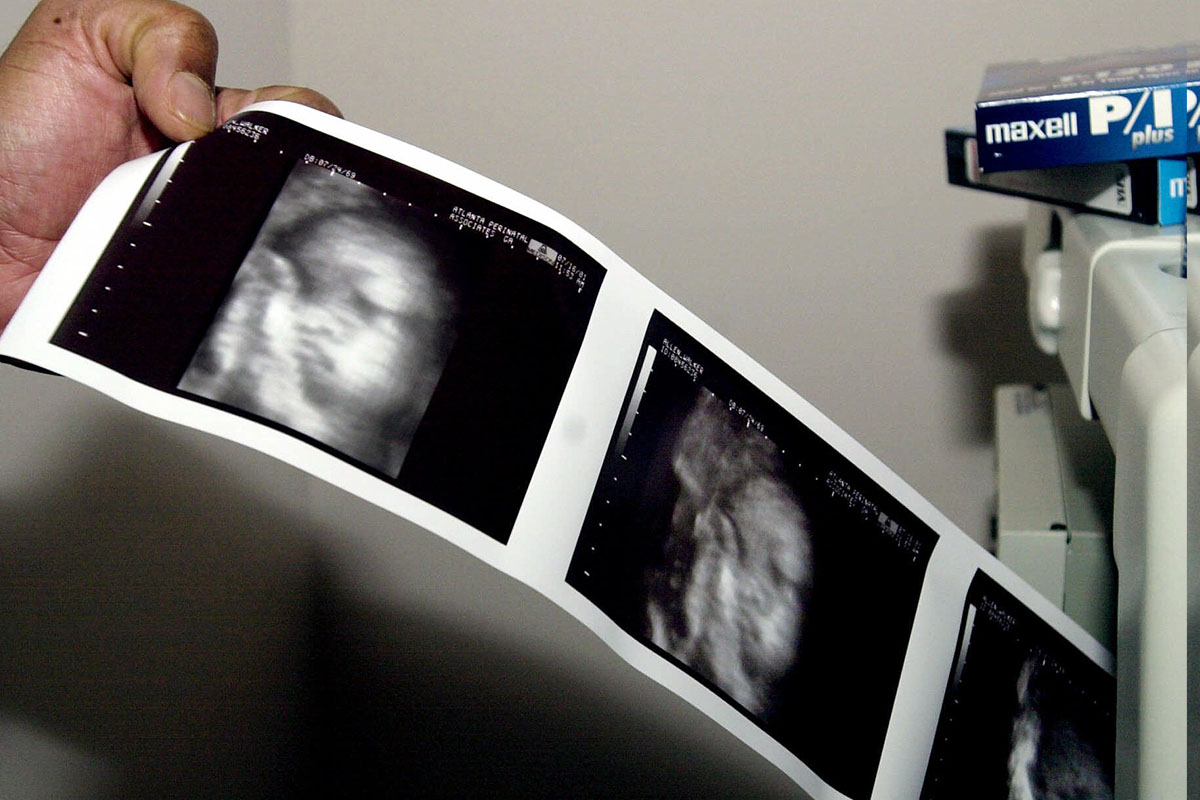Start of life debate sonograms